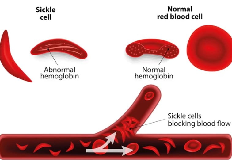 Orak hücreli anemi hastalığı dolaşımı nasıl engeller