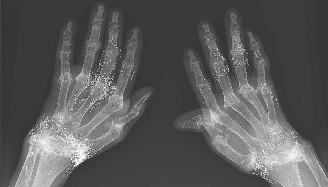 X-Işınları, Bir Kadının Elinin İçinde Altın Kıymıklar Olduğunu Gösterdi