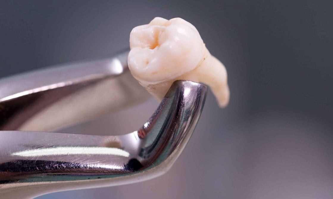 Bilim insanları, 20'lik dişlerimizin neden yetişkinken ortaya çıktığını açıkladı